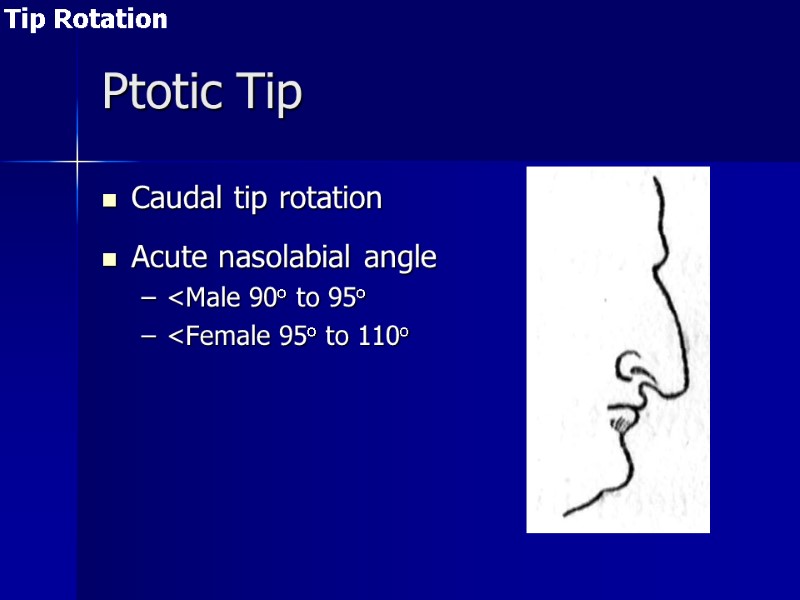 >Ptotic Tip  Caudal tip rotation  Acute nasolabial angle <Male 90o to 95o